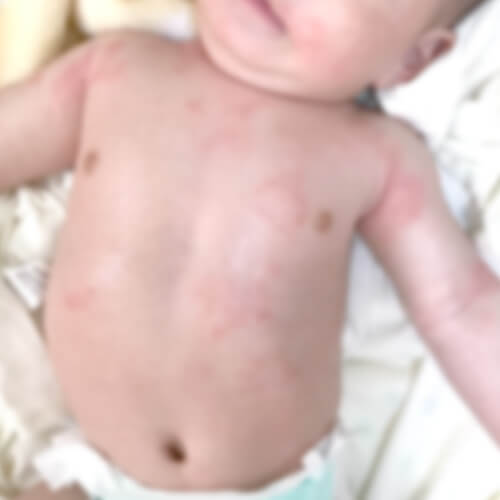 乳児湿疹 肌荒れ 0歳 白色ワセリン 軟膏 アトピー性皮膚炎